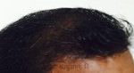 Hair Transplantation