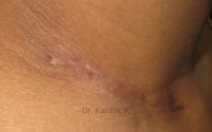 Scar Revision