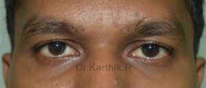 Under Eye Fat Fill