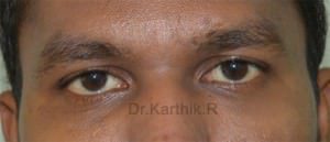 Under Eye Fat Fill