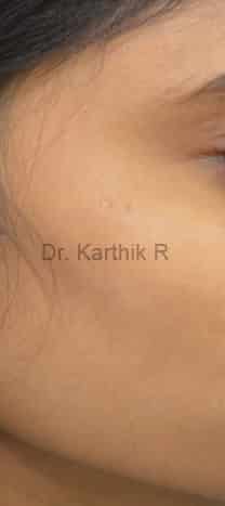Chemical Peels & Microdermabrasion