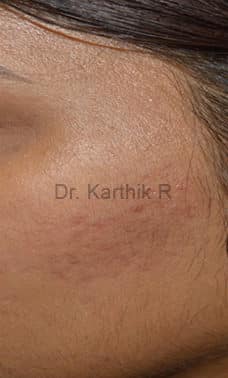 Chemical Peels & Microdermabrasion