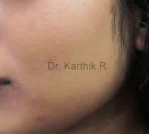 Chemical Peels & Microdermabrasion