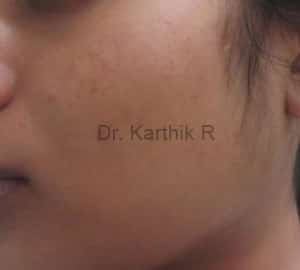Chemical Peels & Microdermabrasion