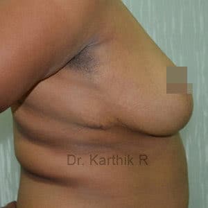 Breast Reduction and Breast Lift