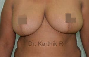 Breast Reduction and Breast Lift