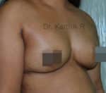 Breast Fat Fill (Breast Augmentation)