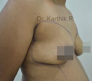 Breast Fat Fill (Breast Augmentation)