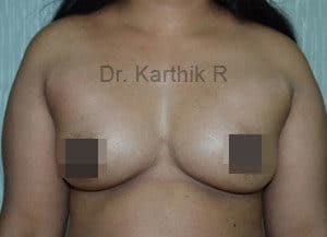 Breast Fat Fill (Breast Augmentation)