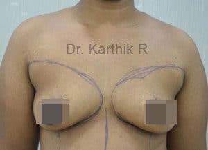 Breast Fat Fill (Breast Augmentation)