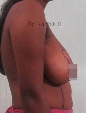 Breast Reduction and Breast Lift