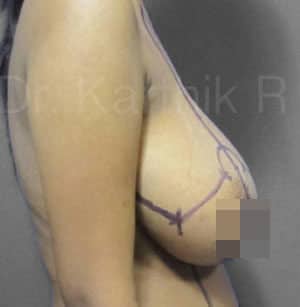 Breast Reduction and Breast Lift