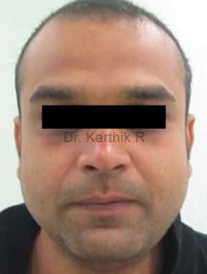 Exilis