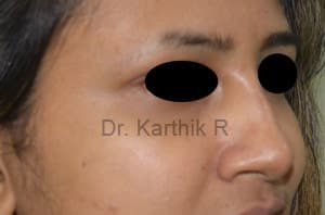 Dermal Fillers