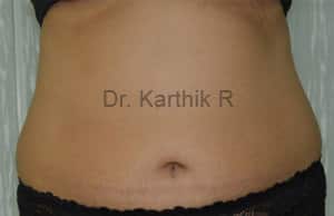 Exilis