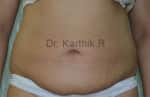 Exilis