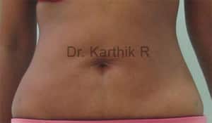 Exilis