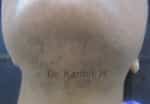 Laser Hair Reduction