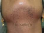 Laser Hair Reduction