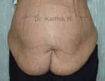 Tummy Tuck