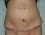 Tummy Tuck