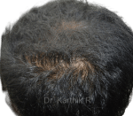 Dermaroller scalp