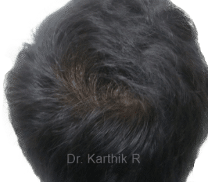 Dermaroller scalp