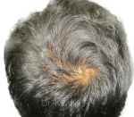 Dermaroller scalp