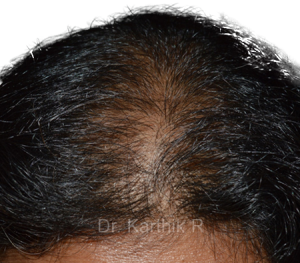 Dermaroller scalp