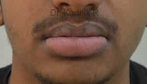 Lip Correction
