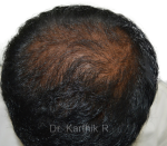 Dermaroller scalp