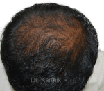 Dermaroller scalp