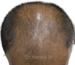 Dermaroller scalp