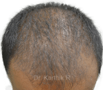 Dermaroller scalp