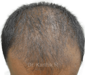 Dermaroller scalp