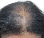 Dermaroller scalp