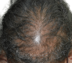 Dermaroller scalp