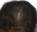 Dermaroller scalp