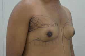 Gynecomastia (Puffy Nipples/ Male Chest Correction)