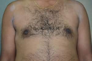 Gynecomastia (Puffy Nipples/ Male Chest Correction)