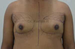 Gynecomastia (Puffy Nipples/ Male Chest Correction)