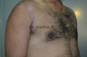 Gynecomastia (Puffy Nipples/ Male Chest Correction)