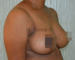 Breast Reduction and Breast Lift