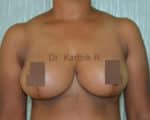 Breast Reduction and Breast Lift