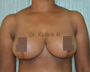 Breast Reduction and Breast Lift