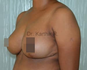 Breast Reduction and Breast Lift