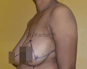 Breast Reduction and Breast Lift
