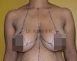 Breast Reduction and Breast Lift