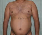 Liposuction Tummy and Back