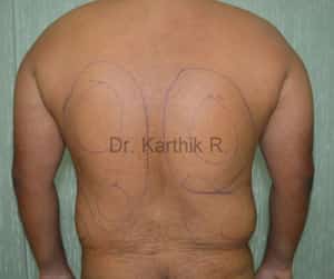 Liposuction Tummy and Back